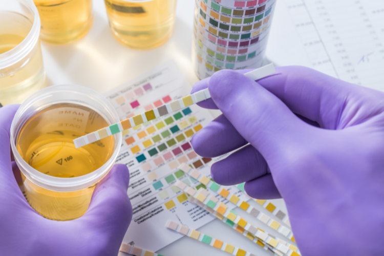 Analyse d'urine en laboratoire avec bandelettes de test - Processus de diagnostic médical et vérification des paramètres de santé.